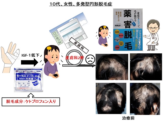 円形脱毛症　病院
